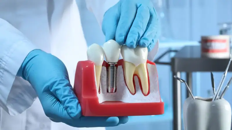 How to Choose the Right Teeth Replacement Option for You