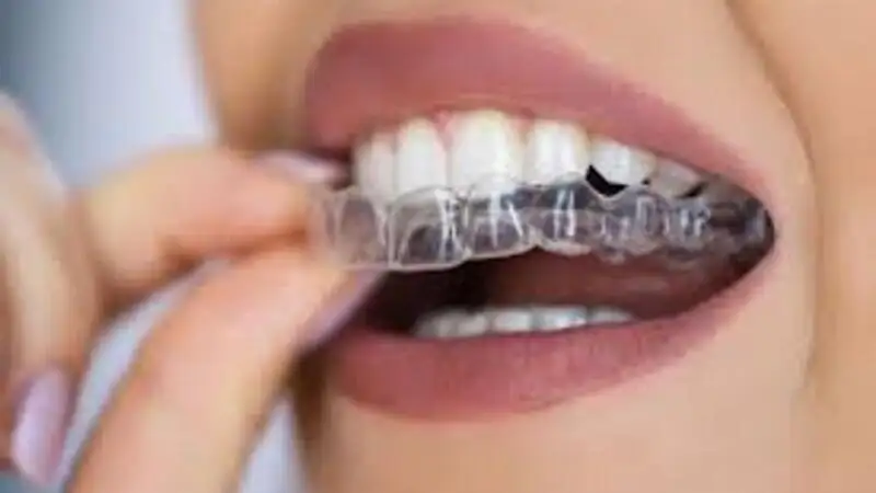 Top Benefits of Choosing Invisalign Over Braces