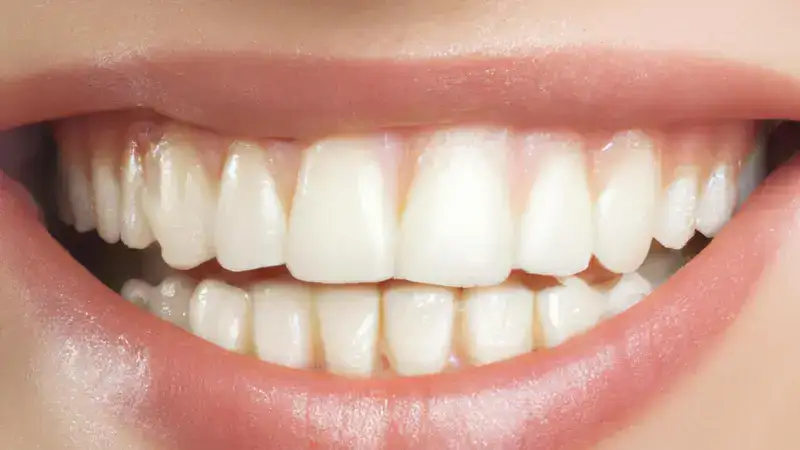 Teeth Whitening