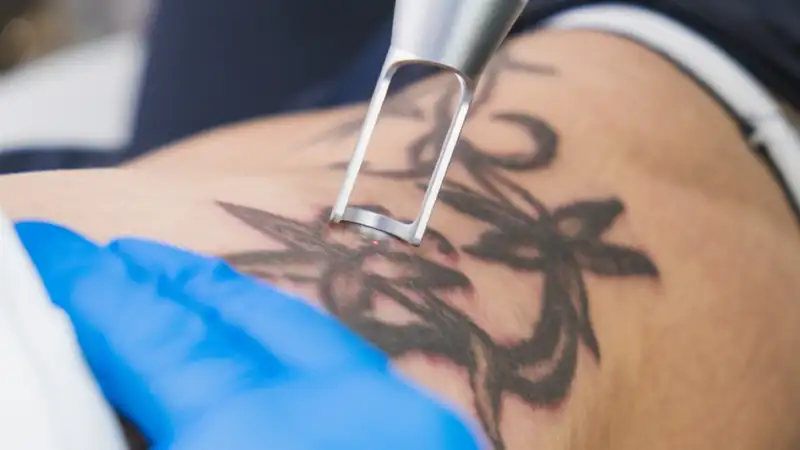 Understanding and Overcoming Common Tattoo Removal Challenges
